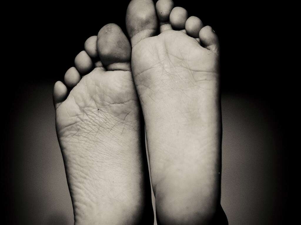 10 Charcot Foot Symptoms