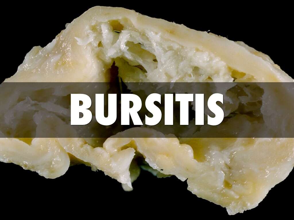 10 Symptoms of Bursitis