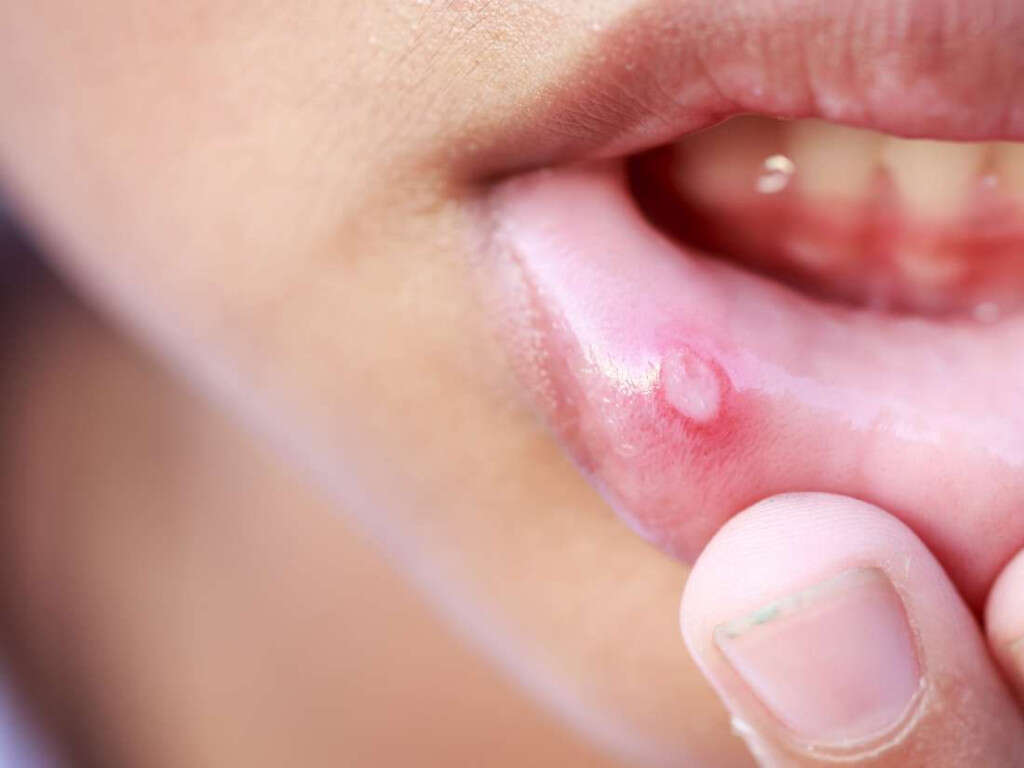 10 Tongue Cancer Symptoms 10faq