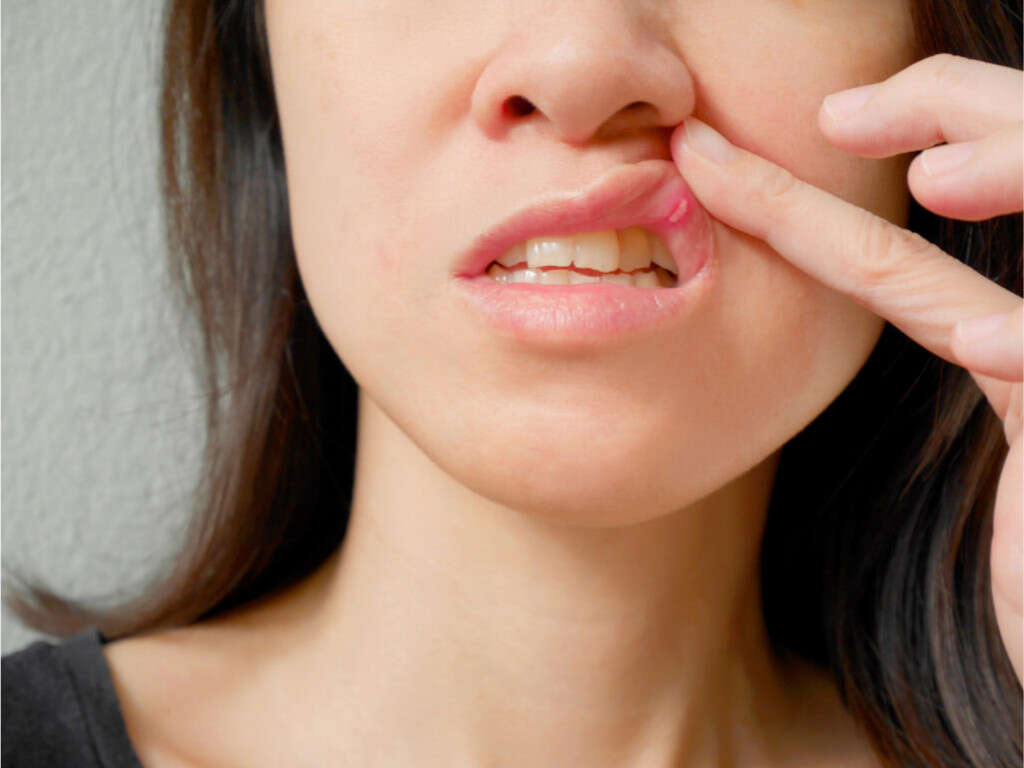 10 Causes of Mouth Ulcers