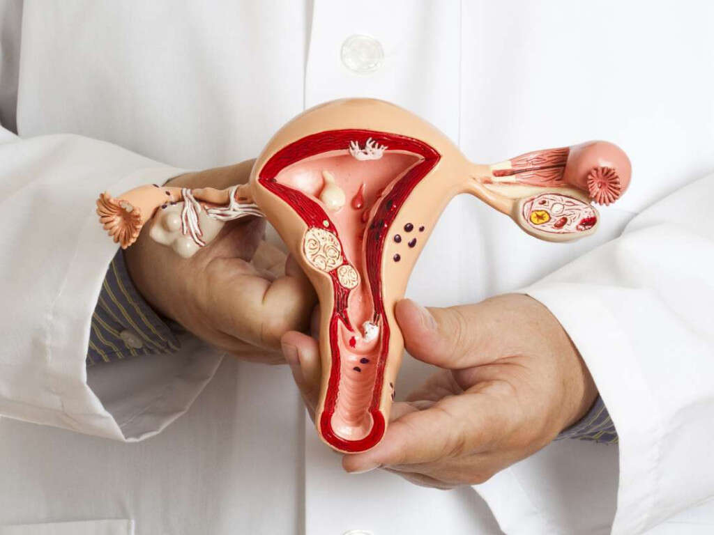 Ovarian Cysts