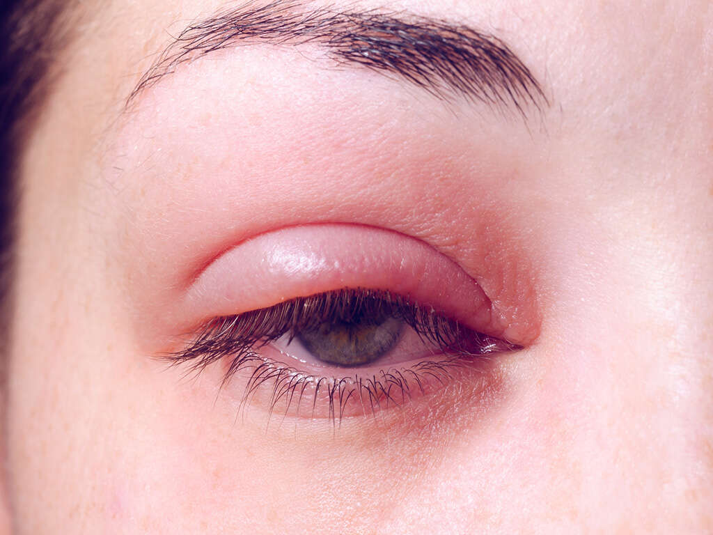 10 Causes of Swollen Eyelids