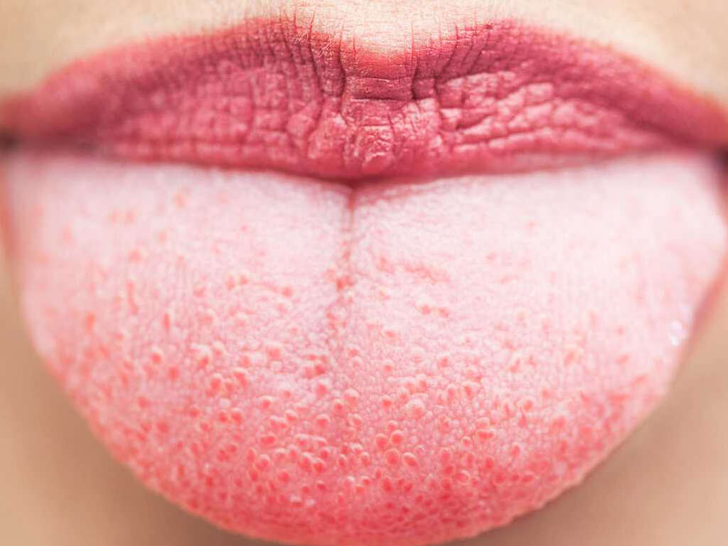 10 Causes of White Tongue