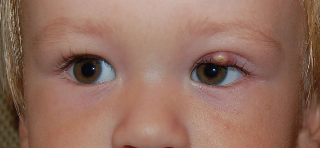 Eye Diseases