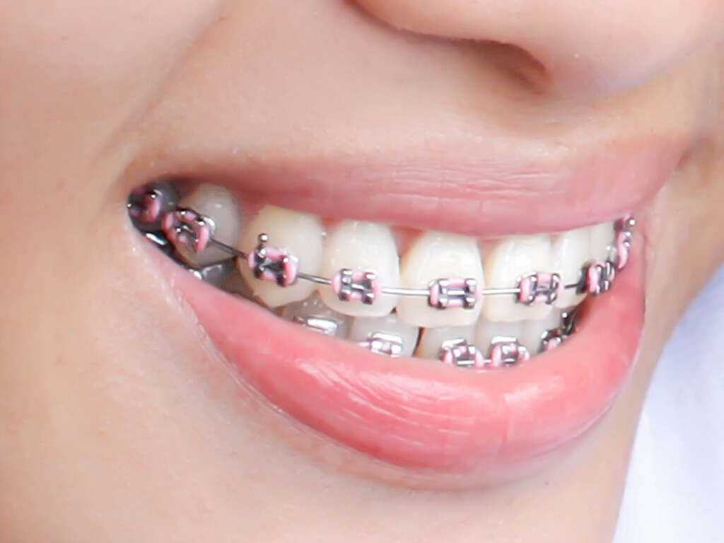 10 Foods To Avoid With Braces