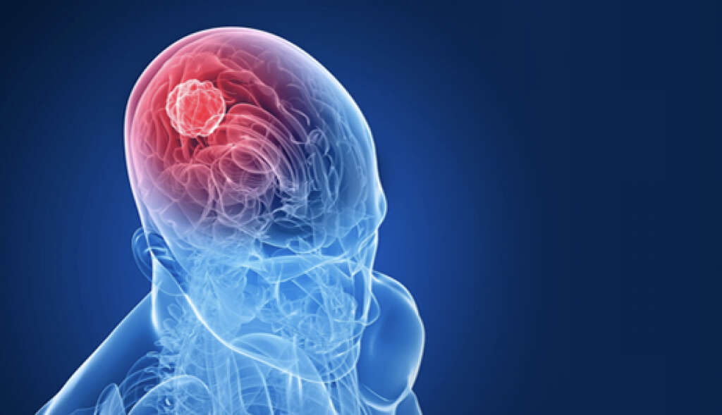 Head Tumor Head Tumor Symptoms