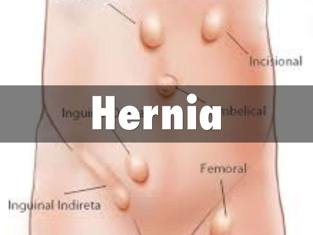 10 Symptoms of Hernia