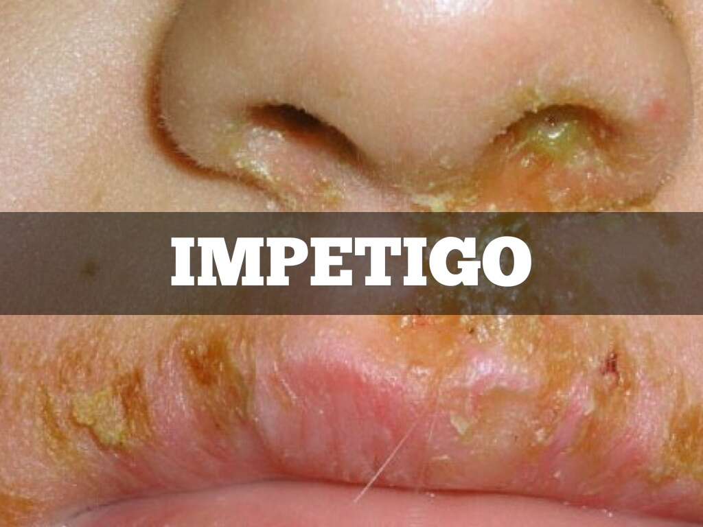 Impetigo Causes, Symptoms & Treatments