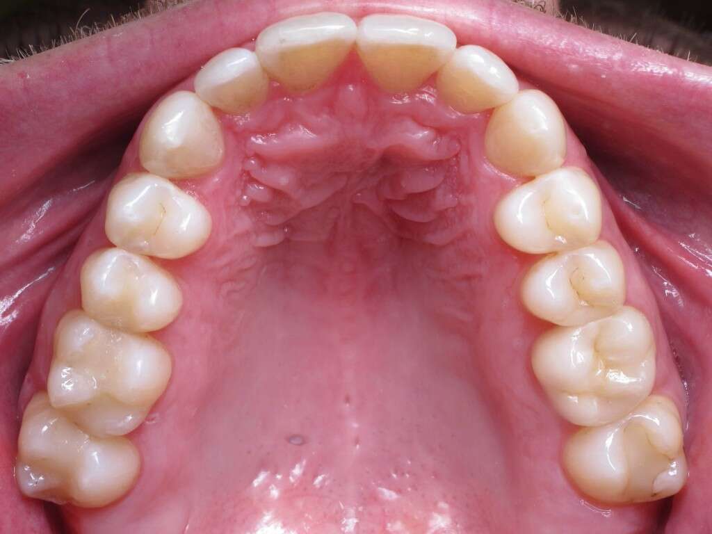 Mouth Cancer