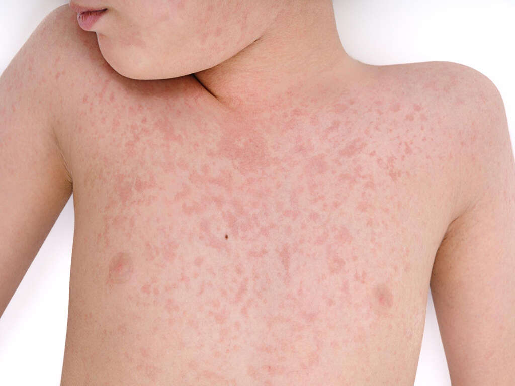 10 Rubella Symptoms