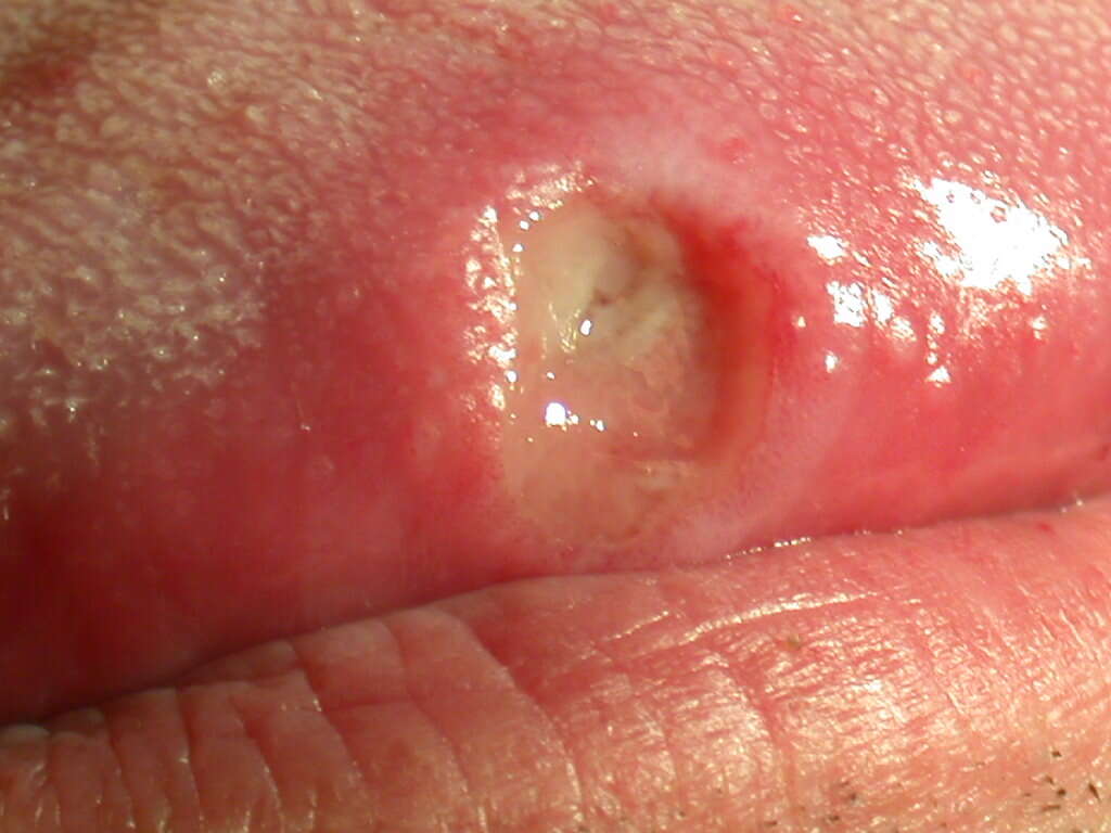 10 Signs of an Ulcer