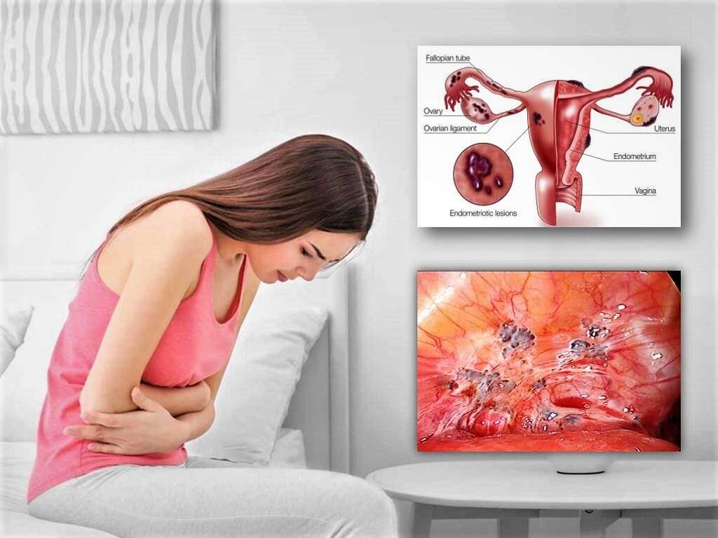 10 Signs of Endometriosis