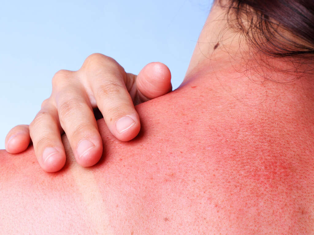 10 Sun Poisoning Symptoms