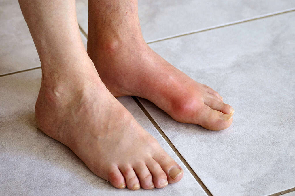 10 Symptoms Of Gout In Foot