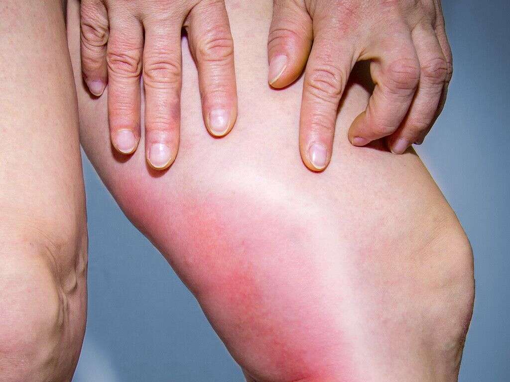 pain-behind-the-knee-causes-picture-symptoms-and-treatment