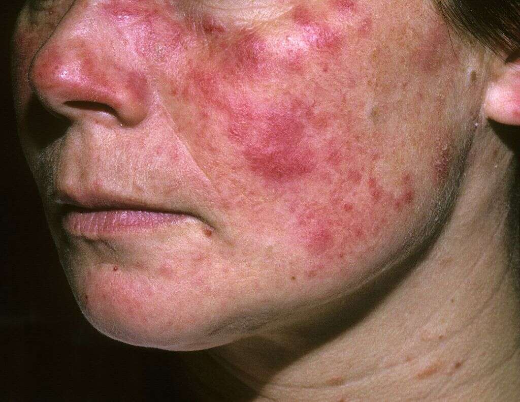 Systemic Lupus