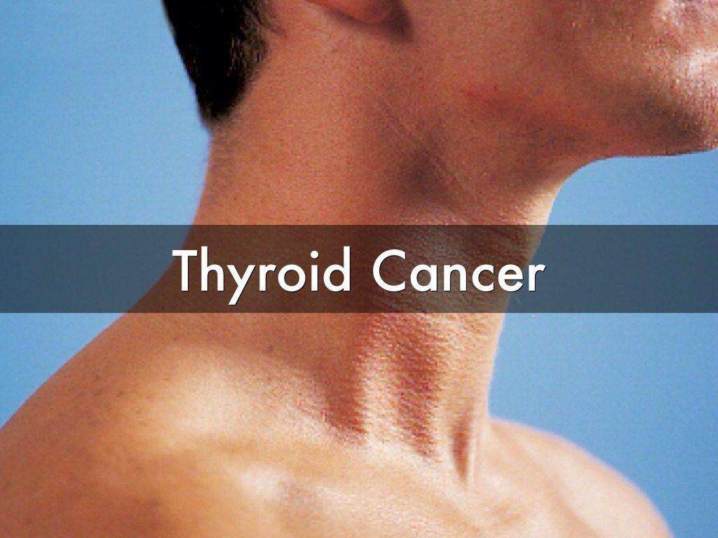 10 Symptoms of Thyroid Cancer