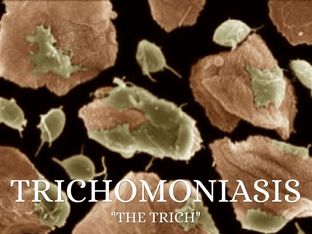 Trichomoniasis