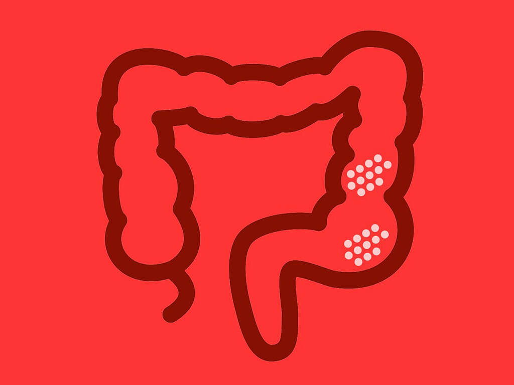 10 Ulcerative Colitis Symptoms
