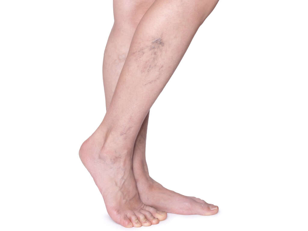 What Causes Varicose Veins?