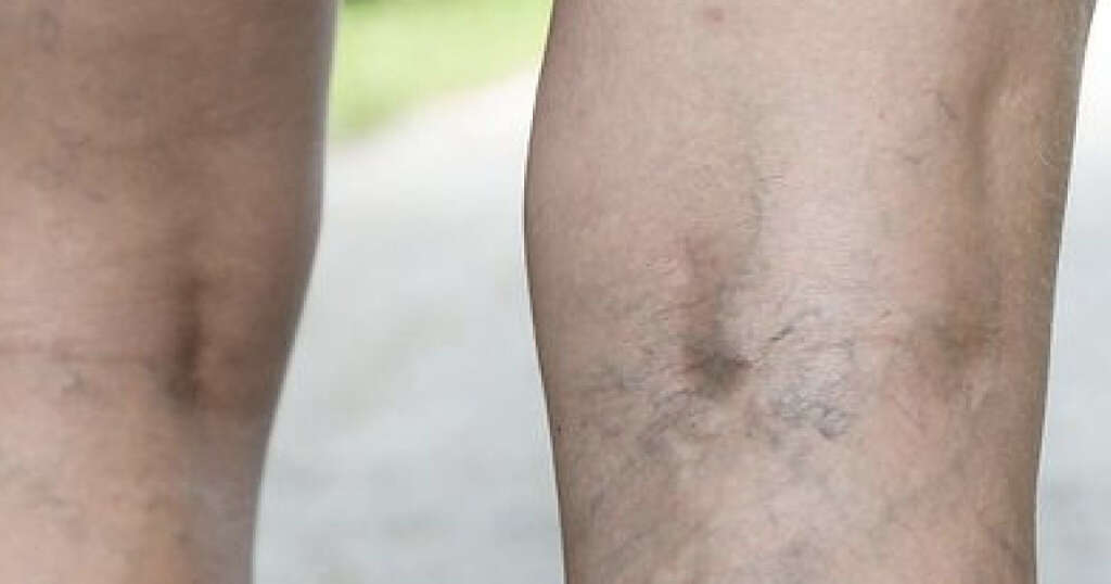 Varicose Veins