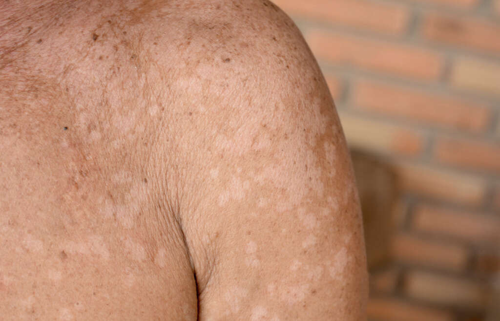 What Causes Small Itchy White Spots On Skin