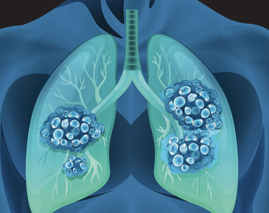 Lung Nodule What Is A Lung Nodule 