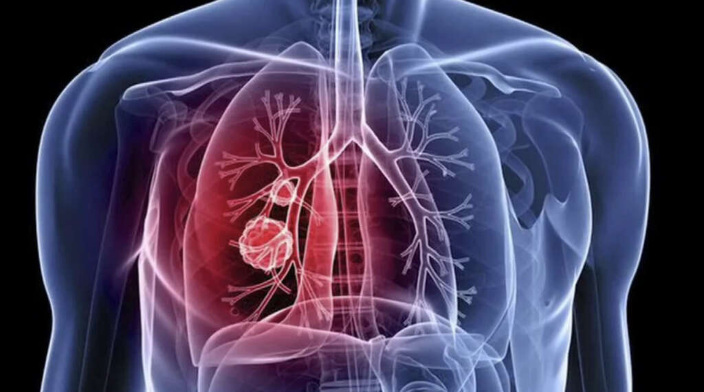 Lung Nodule