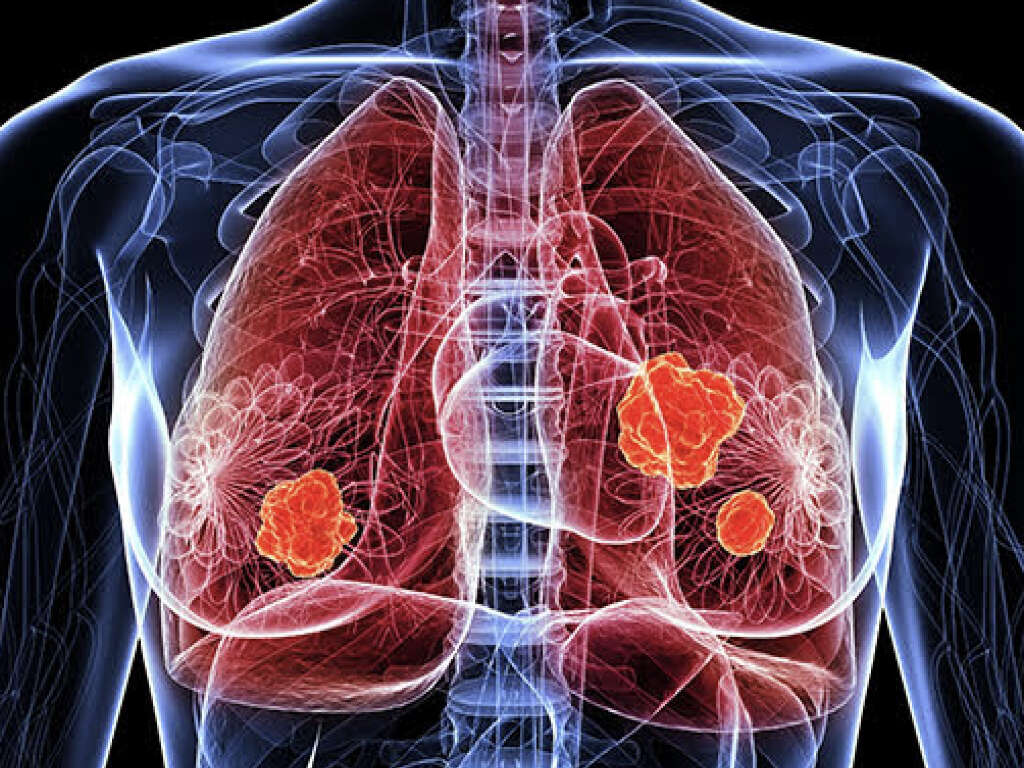 What Is a Lung Nodule?