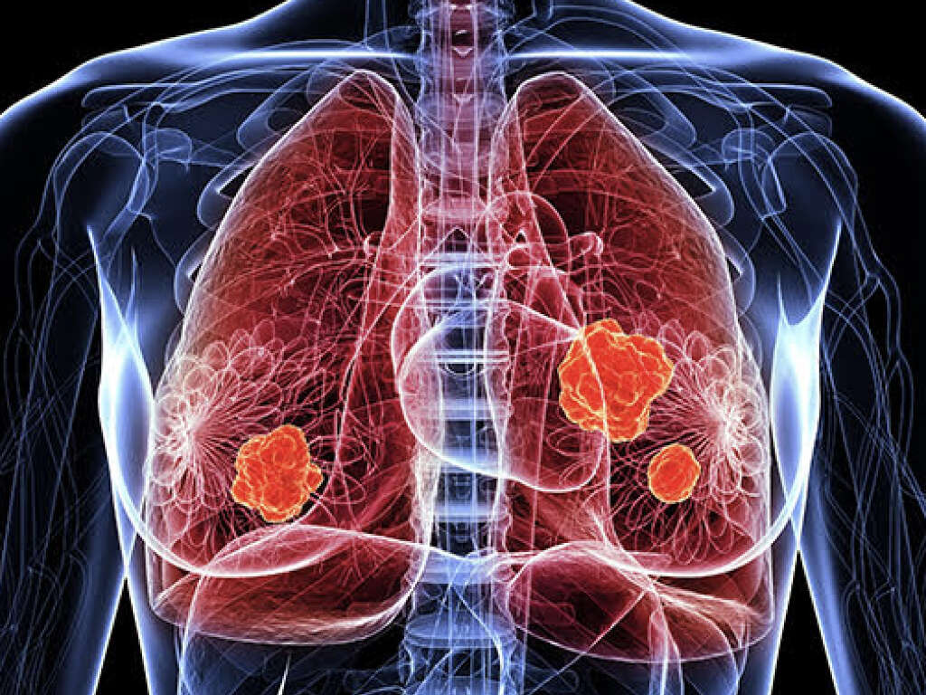 Lung Nodule