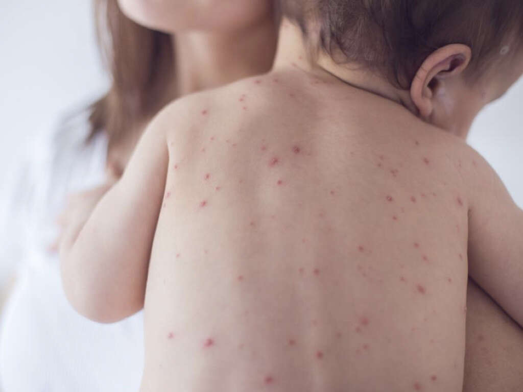 What Is Rubella?
