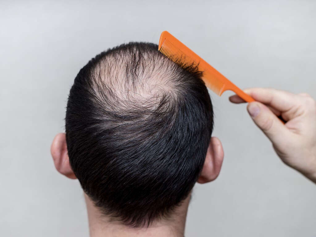 What Is Alopecia Areata?