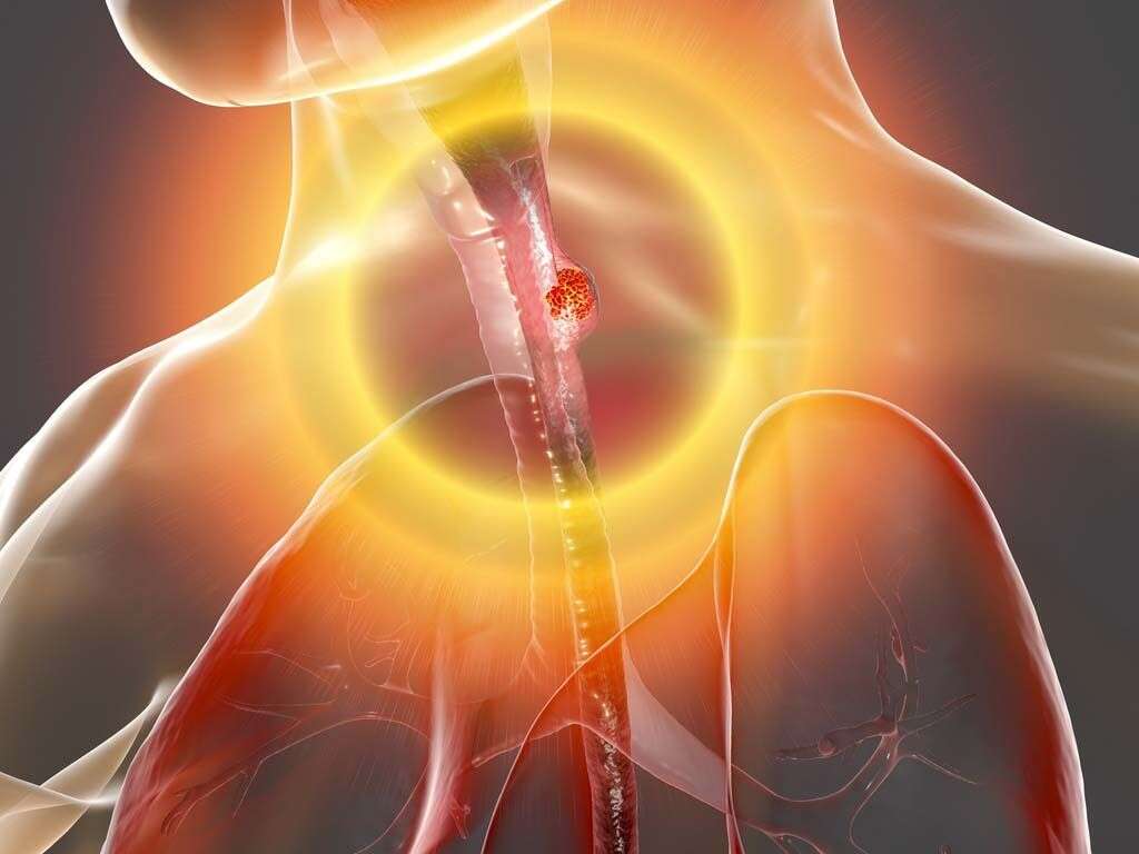 What Is Esophageal Cancer?
