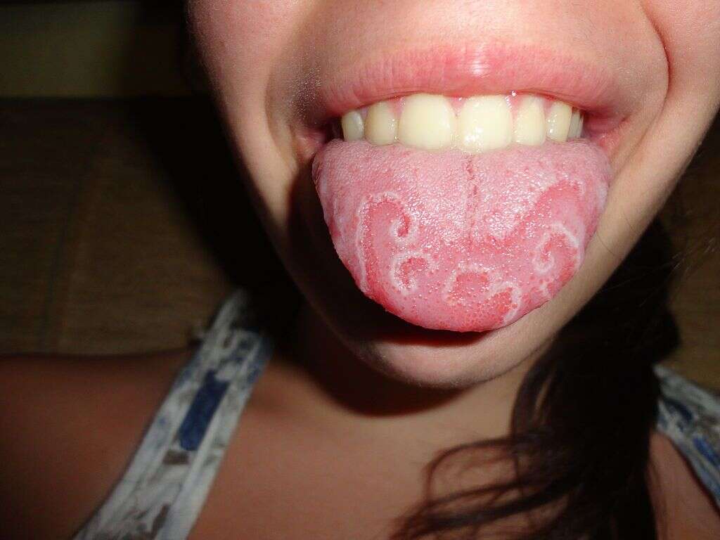 What Is Fissured Tongue?