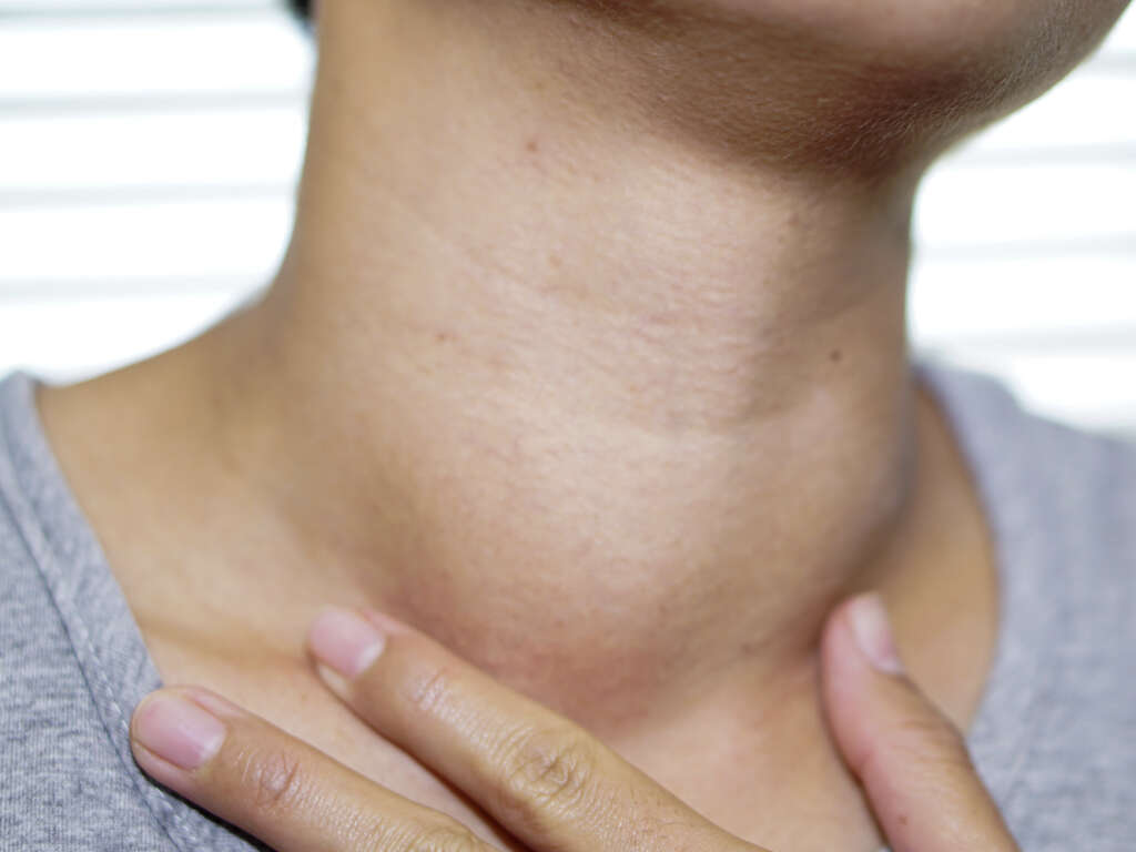 What Is Hyperthyroidism?