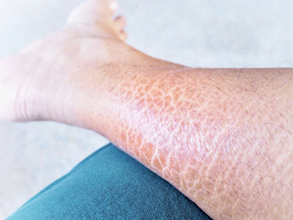 What Is Ichthyosis?