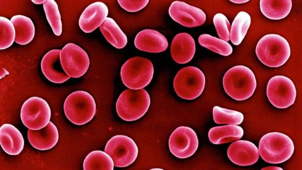 Microcytic Anemia
