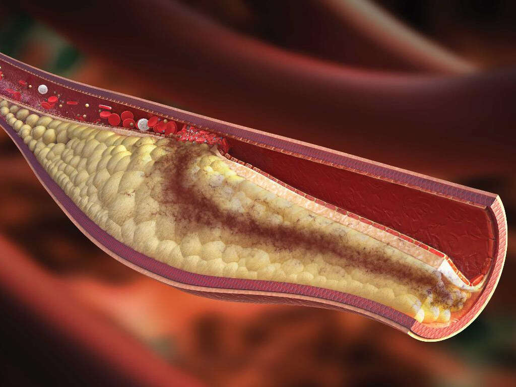 What Is Mixed Hyperlipidemia?