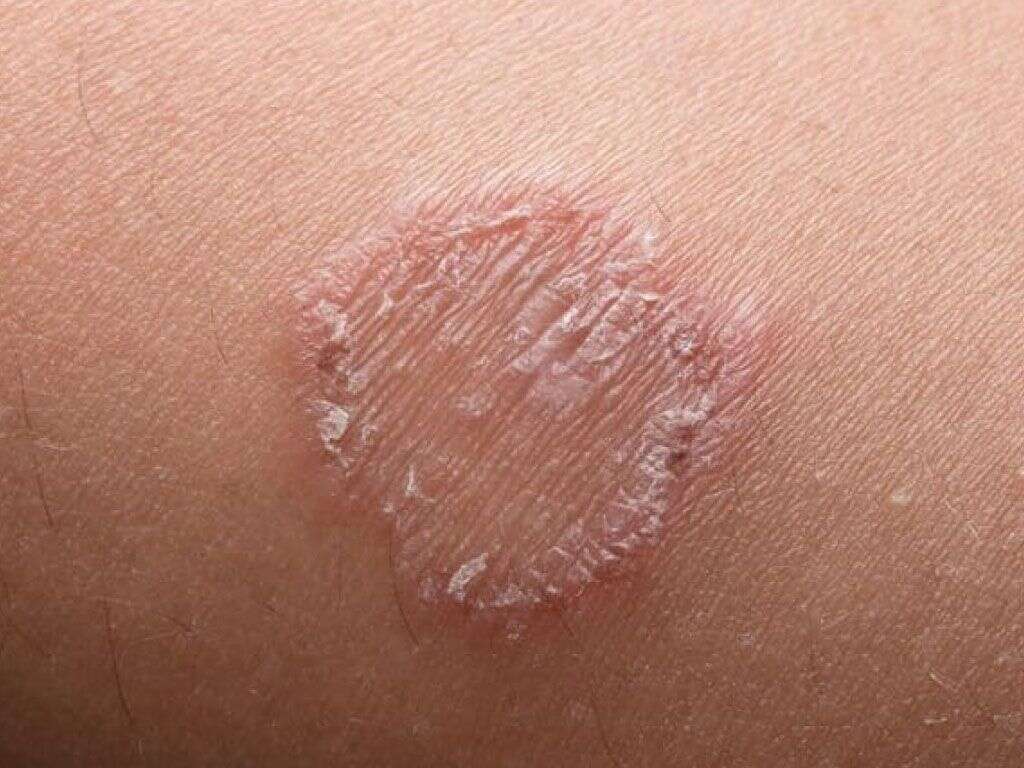 What Is Ringworm Symptoms?