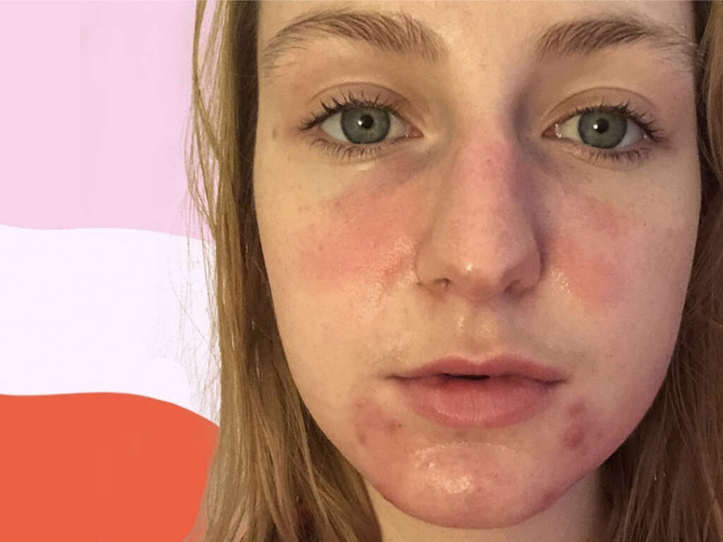 What Is Rosacea?