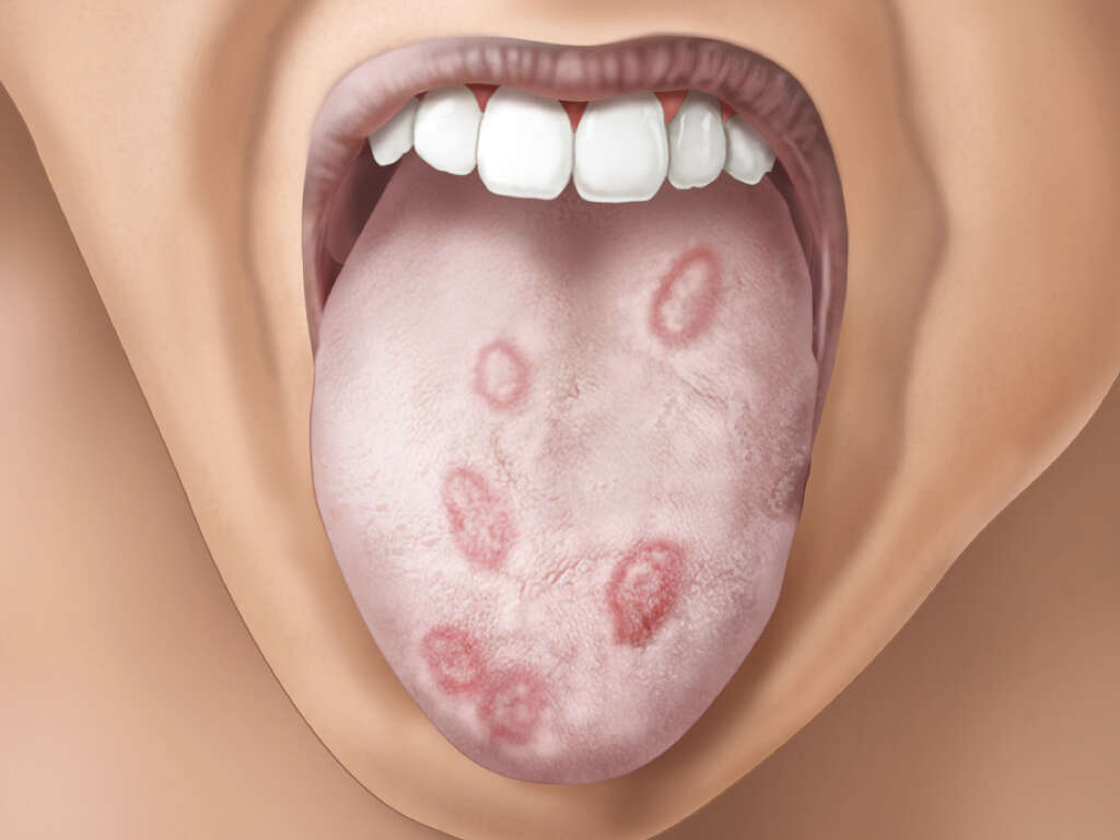 What Is Syphilis?