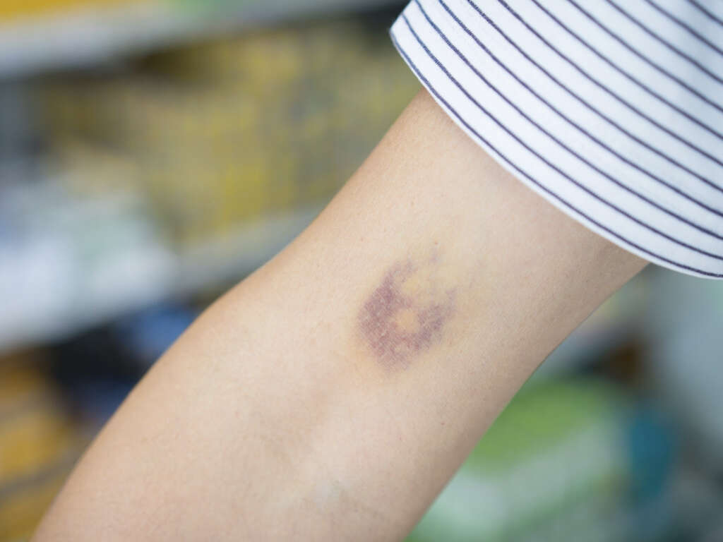 Bruise So Easily