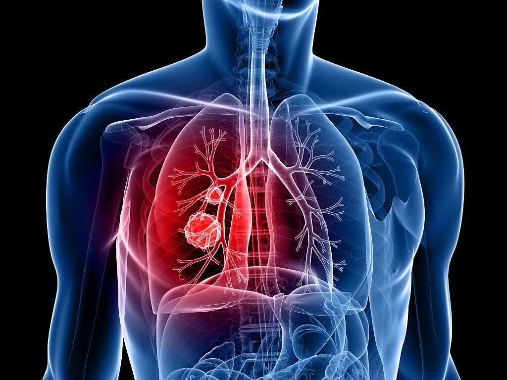 10 Lung Cancer Causes