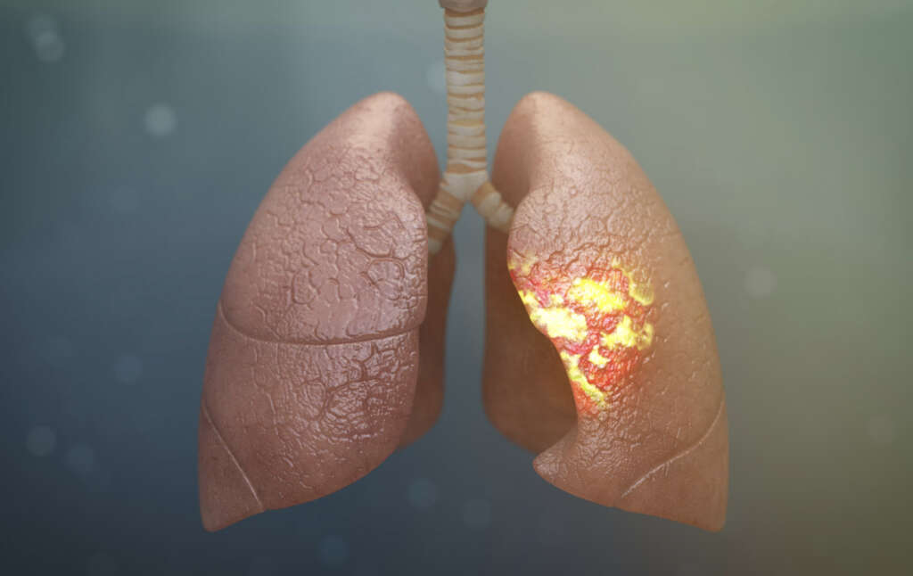 pneumonia-10-pneumonia-causes