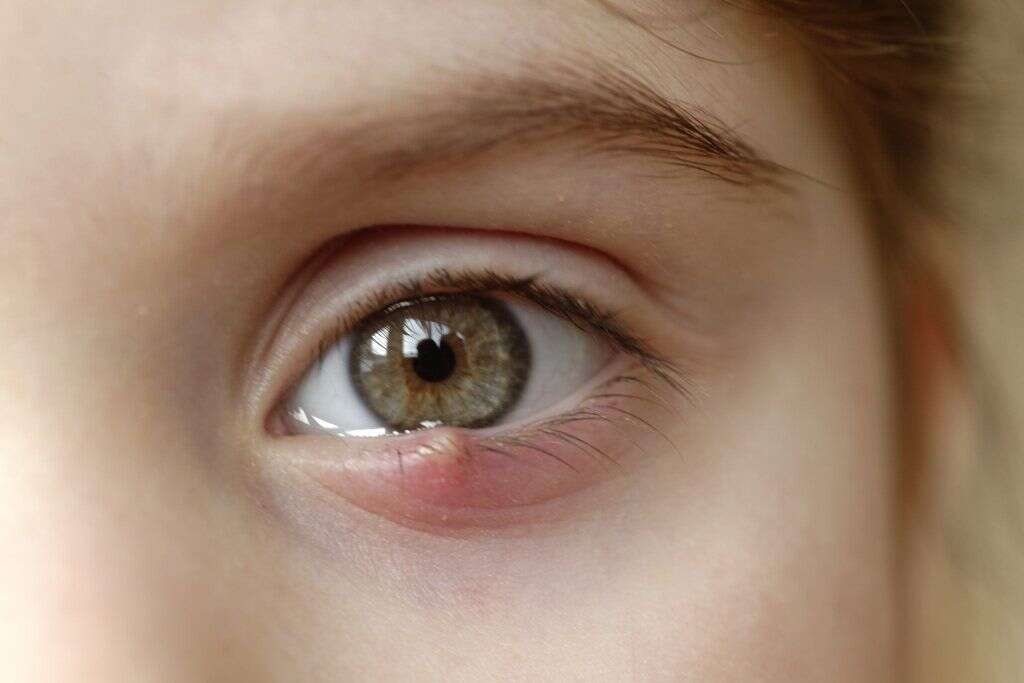 Eye Infections