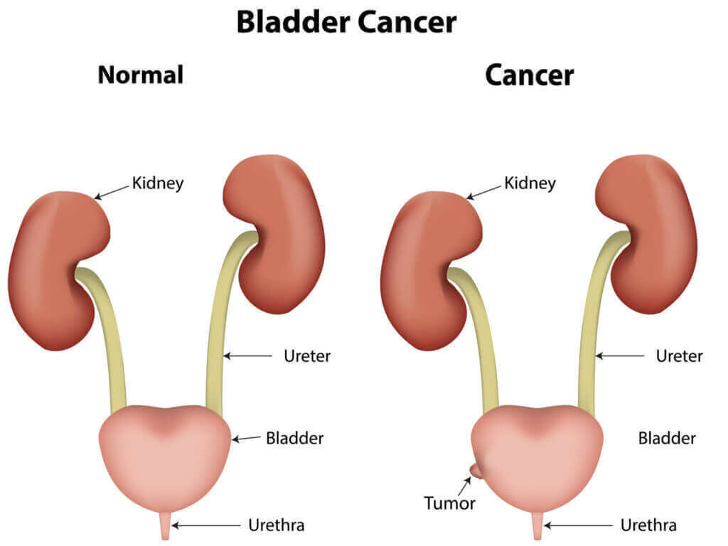 Bladder Cancer