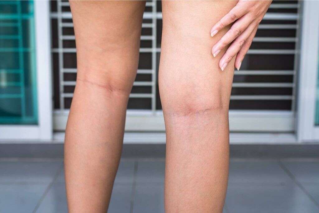 How do I know if my leg pain is normal or blood clot?