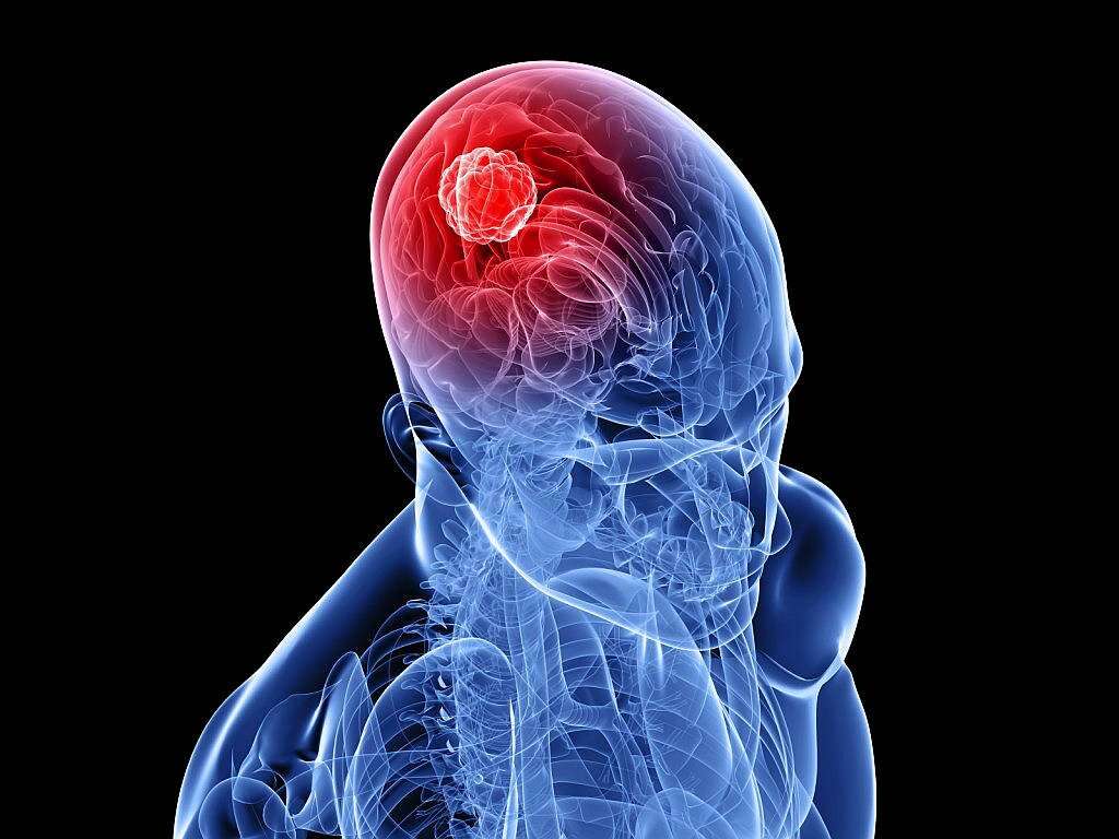 brain-tumor-10-brain-tumor-symptoms