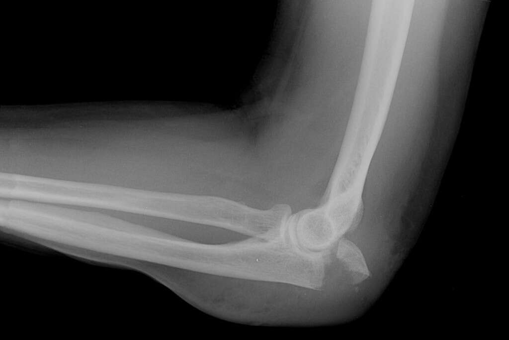 Broken Elbow 10 Broken Elbow Symptoms 7663