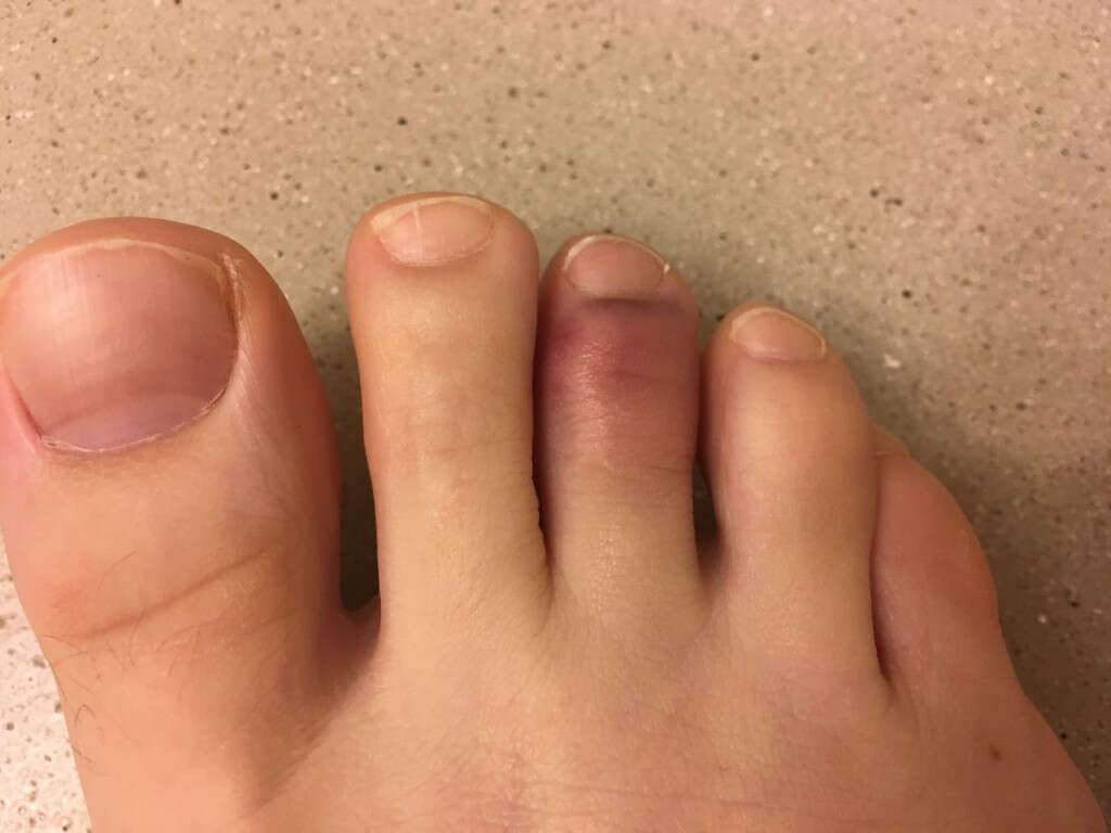 Broken Toe: Symptoms, Causes, Diagnosis, Treatment, and More - wide 3